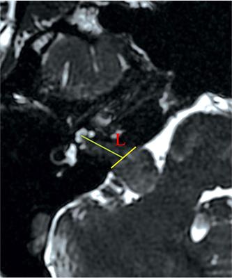 Endoscope-Assisted Retrosigmoid Approach for Vestibular Schwannomas With Intracanalicular Extensions: Facial Nerve Outcomes